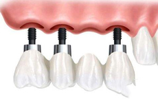 全口牙齿缺失可以做种植牙吗
