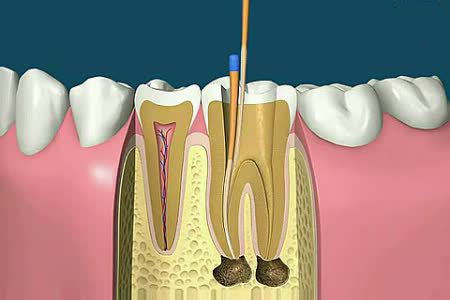 根管治疗2