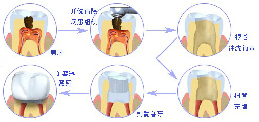 根管治疗