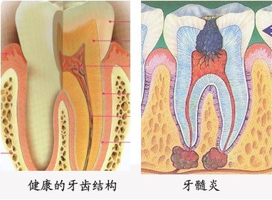 牙髓炎