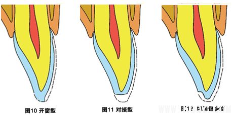 牙贴面类型