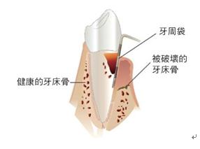 牙周炎