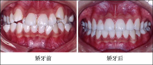 虎牙要不要矫正