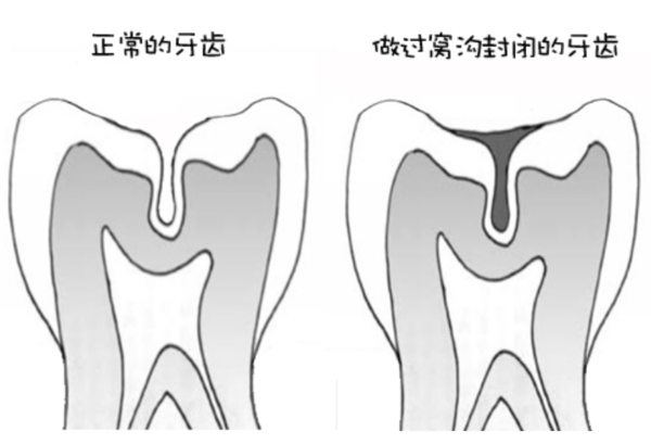 窝沟封闭