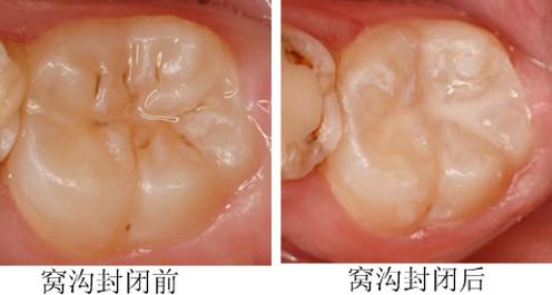 窝沟封闭是怎样做的