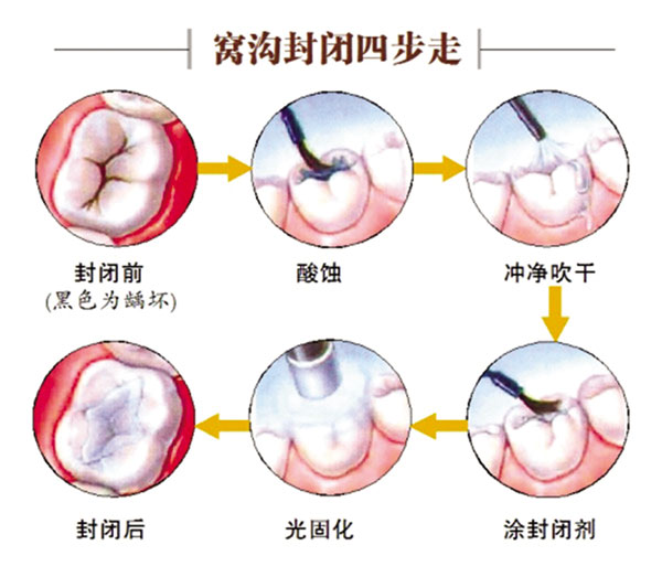 窝沟封闭