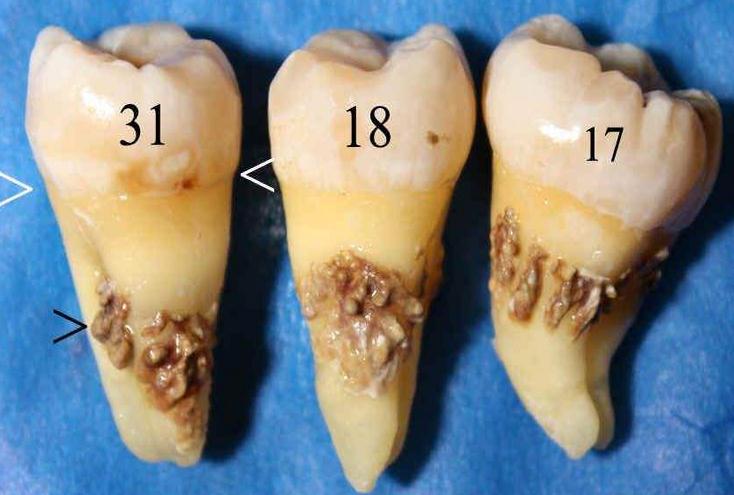 牙结石对口腔有哪些危害