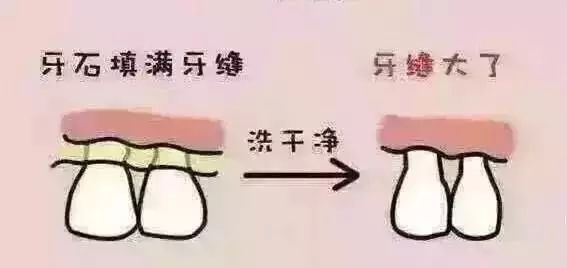 牙结石