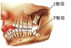 智齿