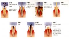 根管治疗的步骤