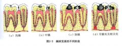 龋齿是什么