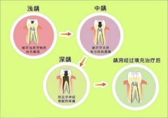 有蛀牙怎么办