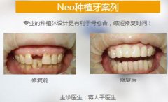 成都种植一颗门牙多少钱