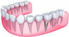 成都种植牙对身体有害吗