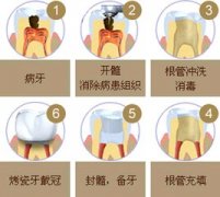 根管治疗多少钱